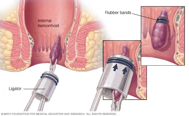 Comprehensive Guide to Hemorrhoids Treatment by Dr. Anuj Tyagi