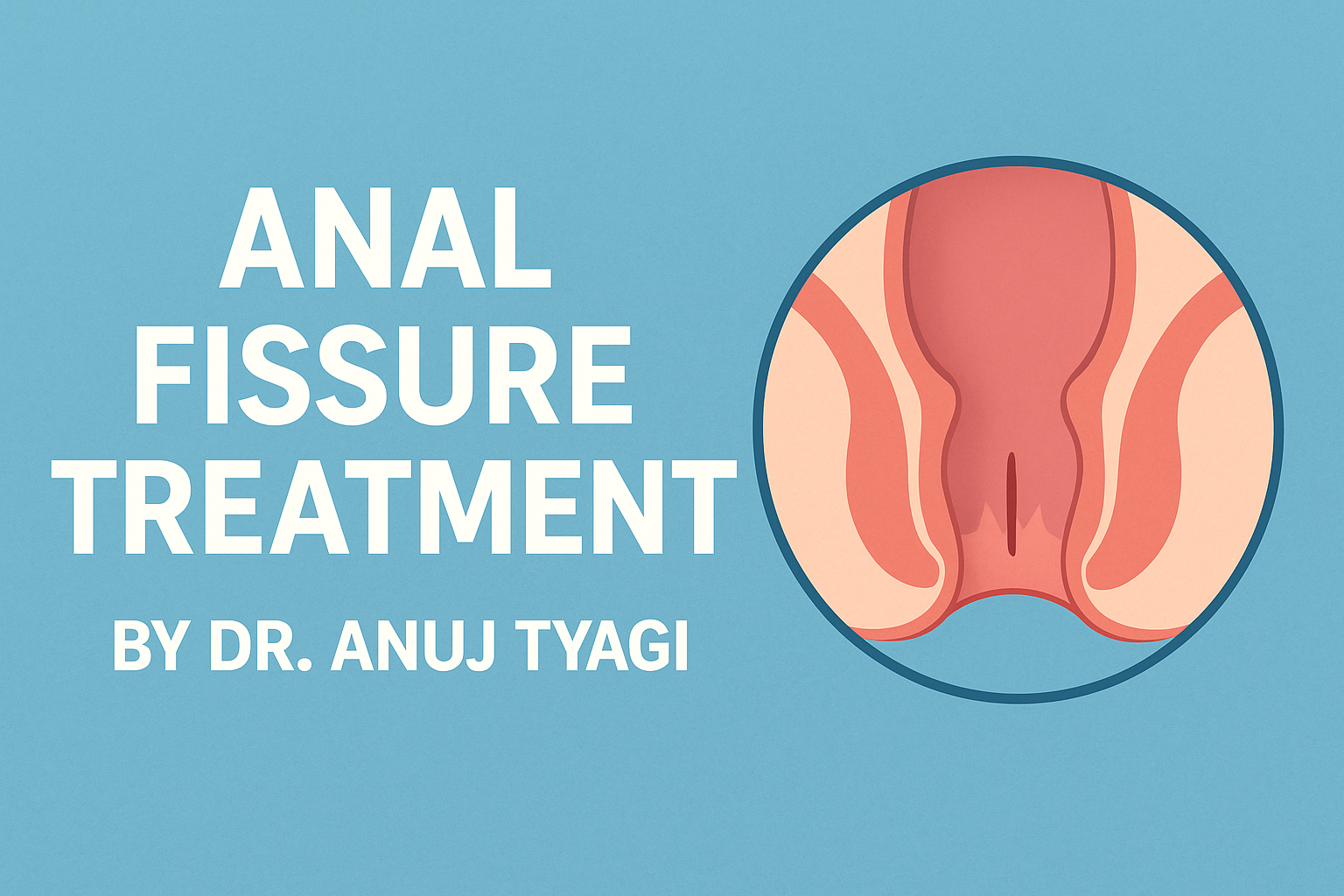Anal Fissure Treatment