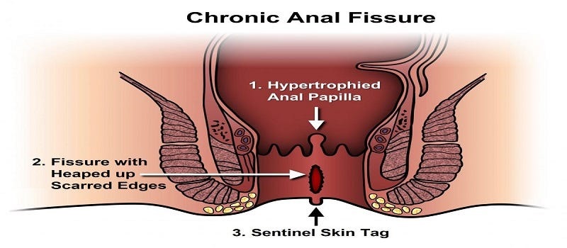 Finding the Best Fissure Treatment in Ghaziabad: Meet Dr. Anuj Tyagi