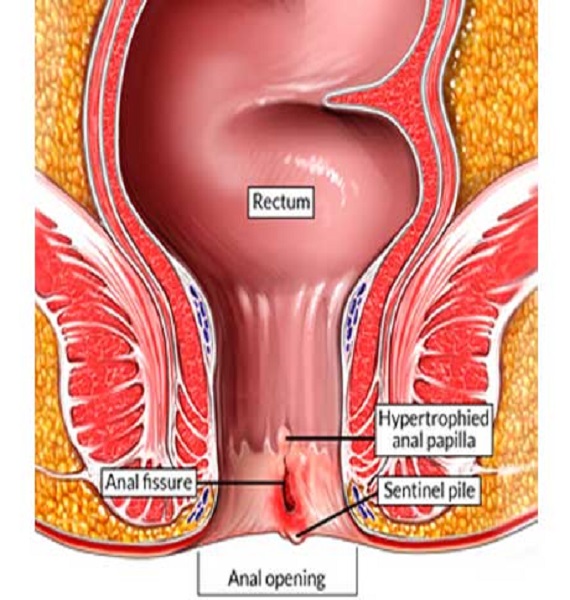 Piles Fistula Clinic Expert Tips for Choosing the Best Fissure Clinic In Ghaziabad