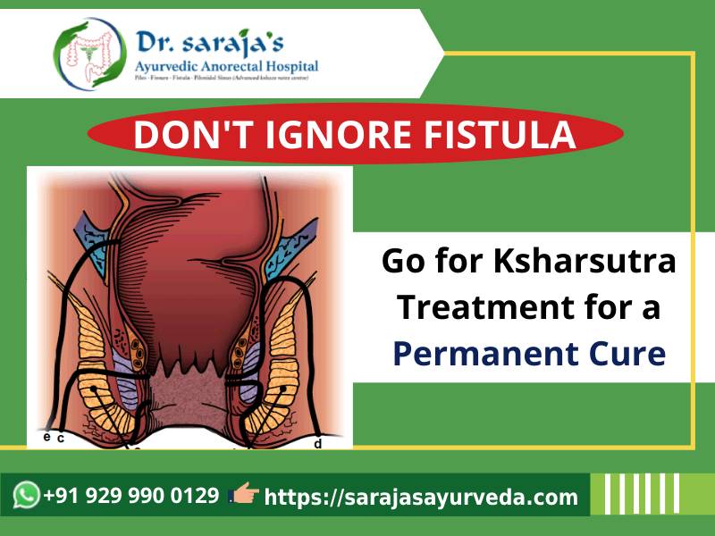 How to Cure Fistula Permanently