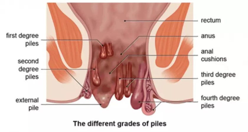 Piles treatment in Delhi NCR