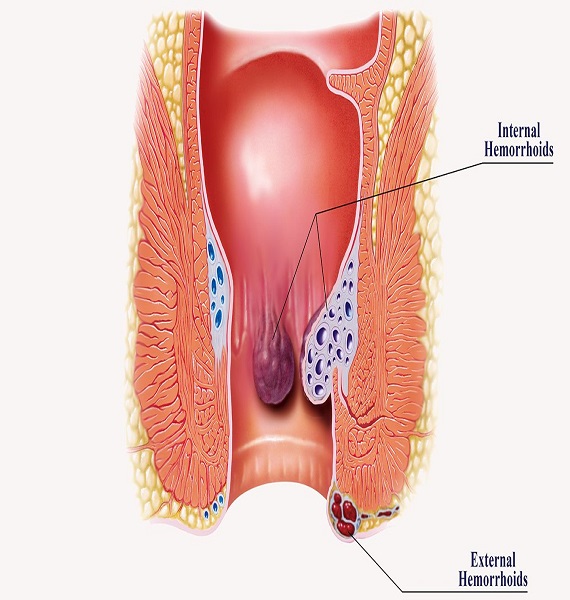 Piles Causes Symptoms Treatment and Prevention