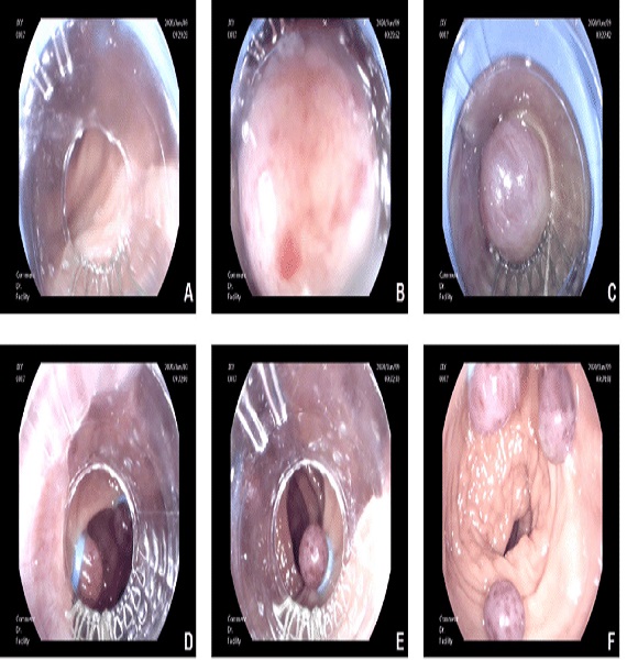 Different Types of Hemorrhoids Piles