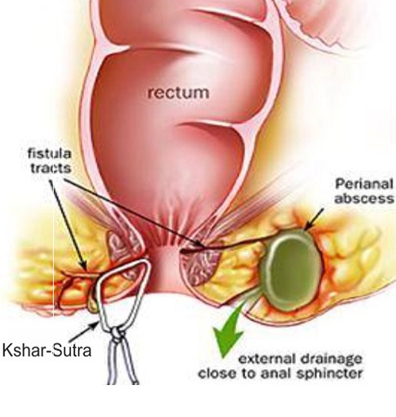 Benefits of Choosing Kshar Sutra Treatment for Piles and Fistula