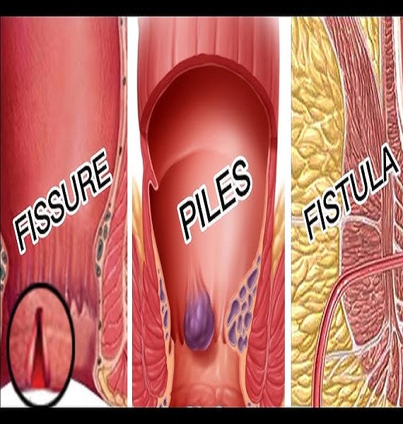 Difference Between Piles and Fissure and Fistula