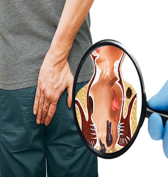 Best Piles Specialist Doctor in Ghaziabad, Piles Fistula Clinic