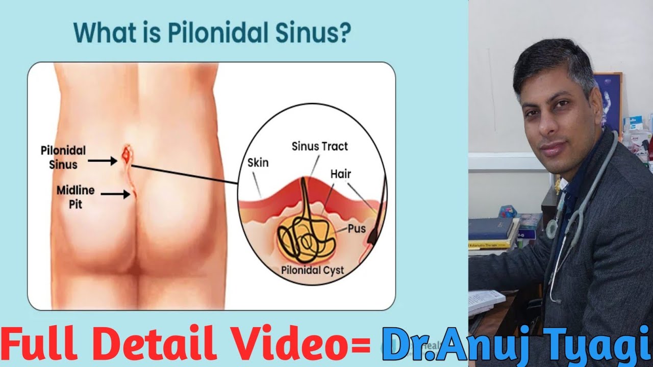 Comprehensive Guide to Piles Treatment in Delhi NCR by Dr. Anuj Tyagi