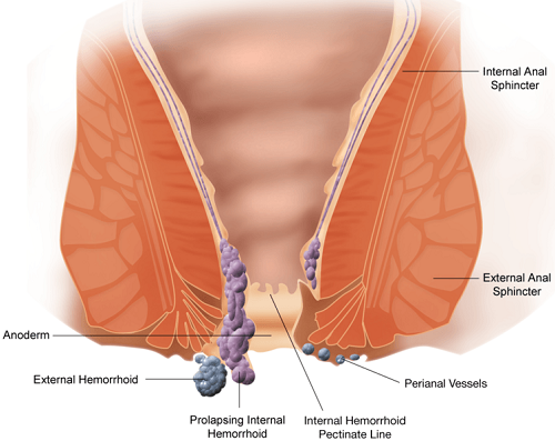 Best Solution for Comfortable Living: Effective Care for Piles