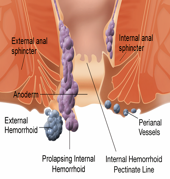 What causes internal and external hemorrhoids and simple ways to treat them?