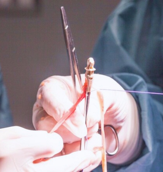 Best Kshar Sutra Therapy for Piles at Piles Fistula Clinic