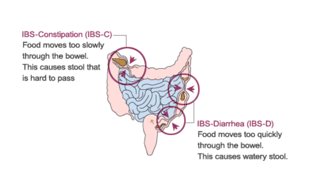 1639228653-Irritable-Bowel-Syndrome-IBS-2.png